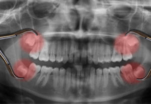 wisdom teeth