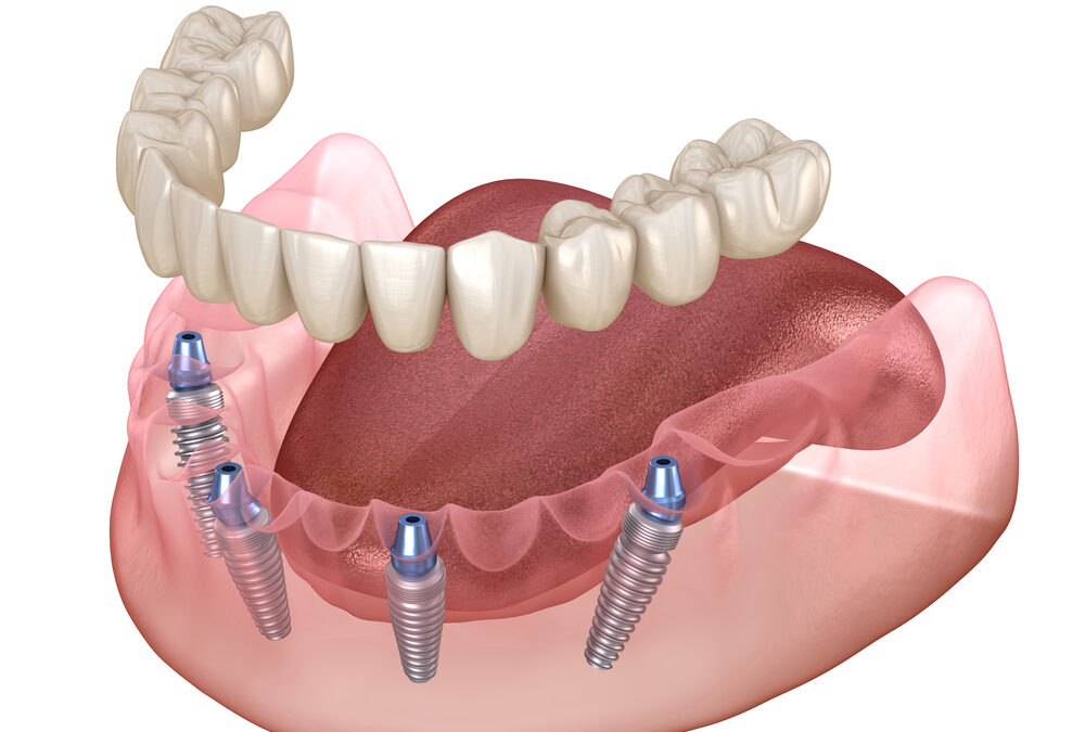 All On 4: Dental Implants With Staying Power