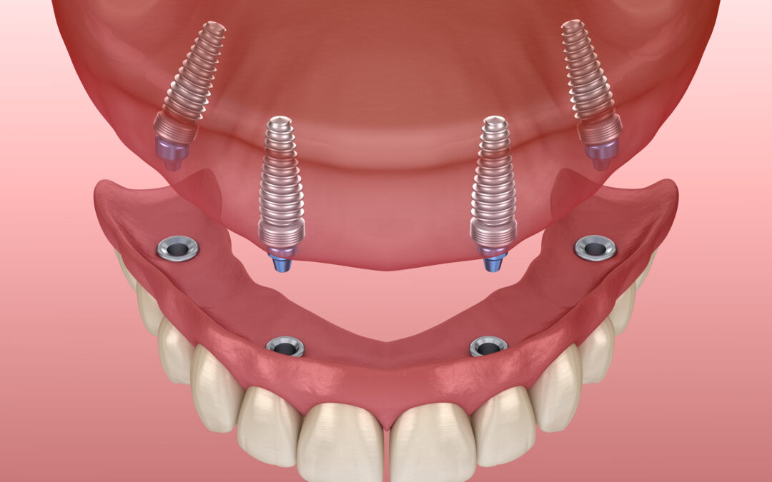 All On 4 Dental Implants: Pain and Risks