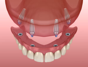 All On 4 Dental Implants